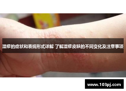 湿疹的症状和表现形式详解 了解湿疹皮肤的不同变化及注意事项 湿疹的症状和表现形式详解 了解湿疹皮肤的不同变化及注意事项